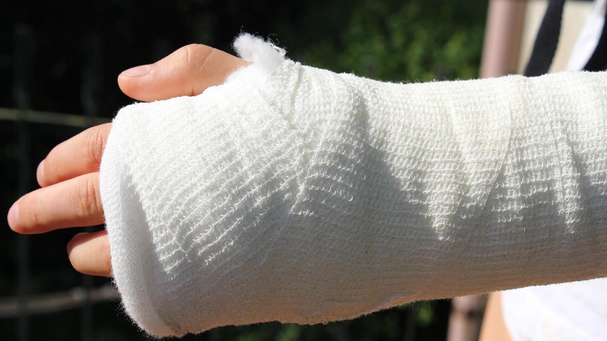 Persoa cun brazo enxesado | Foto: Pixabay